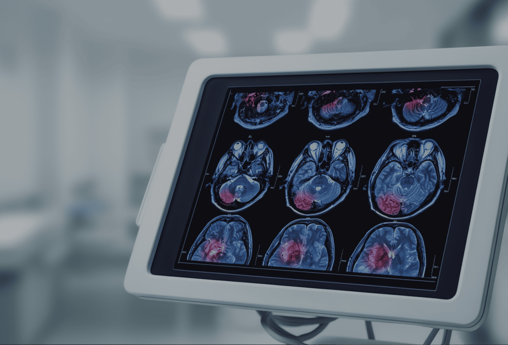 Traumatic brain injuries (TBI)