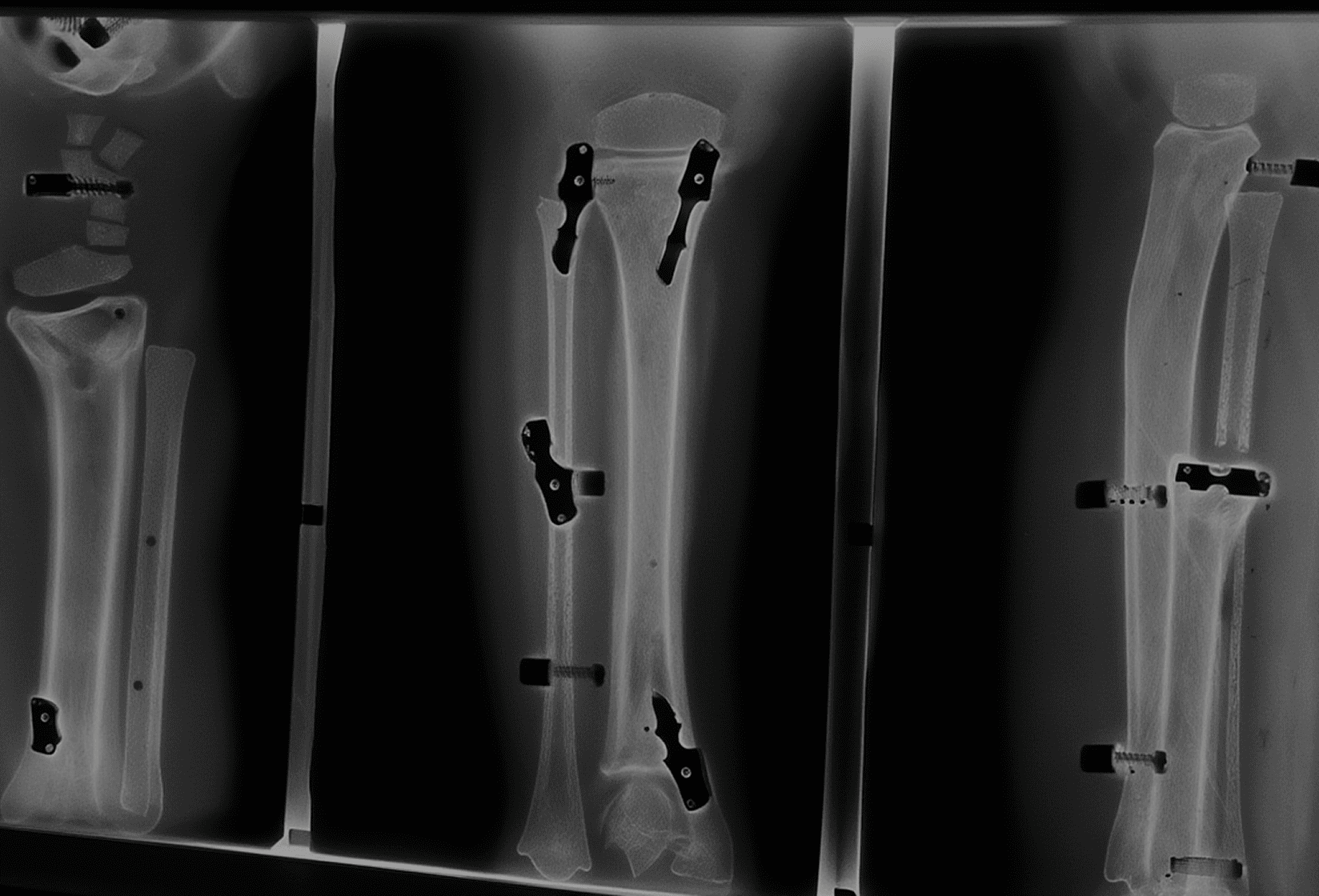 Multiple or complex bone fractures